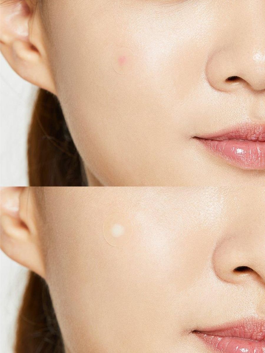 Acne pimple Master 24 patches